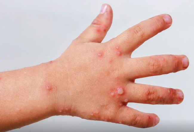 Çimərliklərdən uşaqlara virus yayılır? - Suçiçəyinə bənzəyir, lakin...