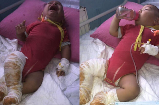 11 aylıq körpənin üstünə qaynar çaydan aşıb: Yardıma ehtiyacı var - FOTO