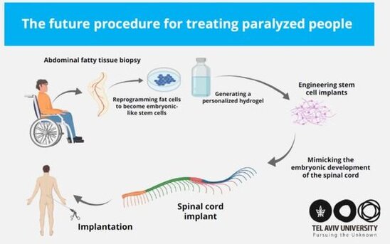 İflic insanları ayağa qaldıracaq yeni ümid: Onurğa beyni implantı yaradıldı - FOTO