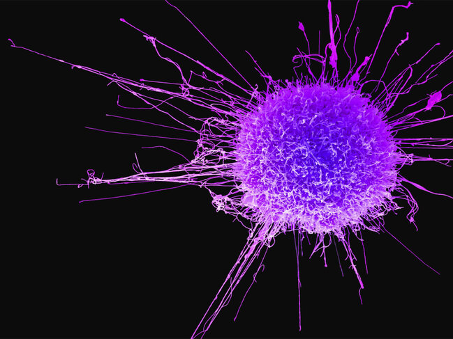 Alimlər mədə-bağırsaq xərçənginin inkişaf səbəbini tapdı