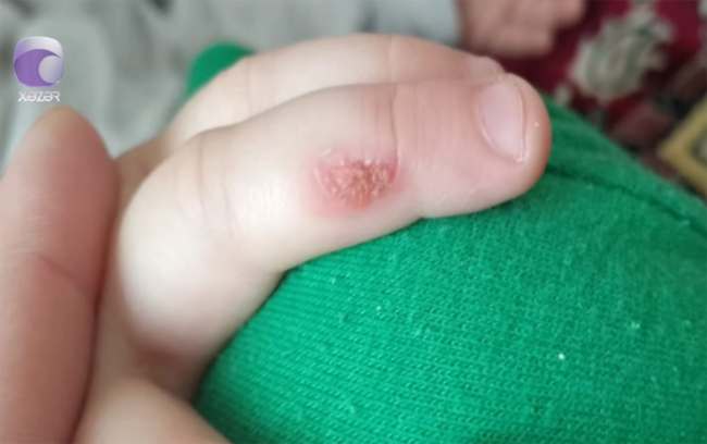 "3 yaşlı uşağım bağçada ağlayanda bıçağı qızdıraraq əlinə basıb" - Video