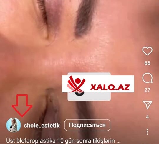 Şölə Məmişova "Aristokrat"da estetik prosedurları icra edir?