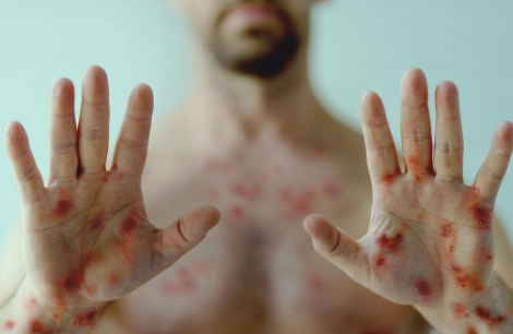 Azərbaycanda meymunçiçəyi virusu ilə bağlı daha bir qurum HƏRƏKƏTƏ KEÇDİ