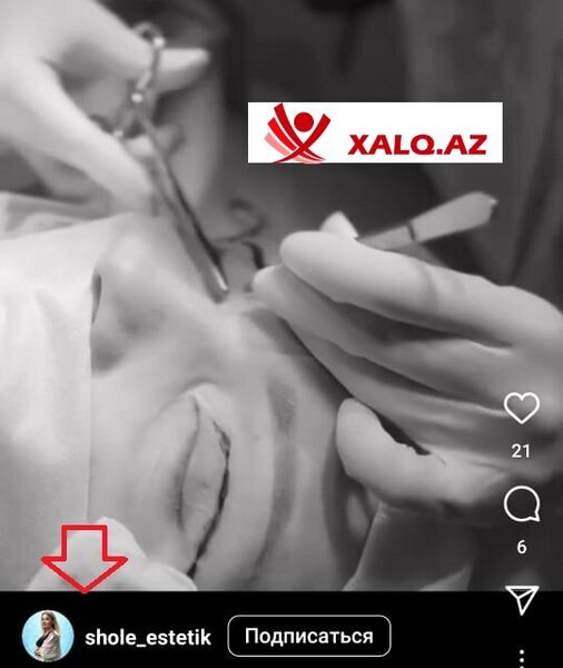 Şölə Məmişova "Aristokrat"da estetik prosedurları icra edir?