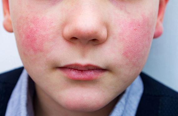 Alimlər uşaq allergiyaları haqqında məşhur mifi təkzib etdilər