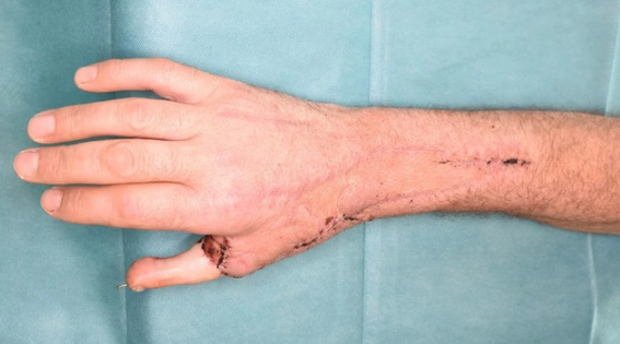 Avstriyada unikal əməliyyat: Əl barmağın yerinə ayağın baş barmağı tikildi