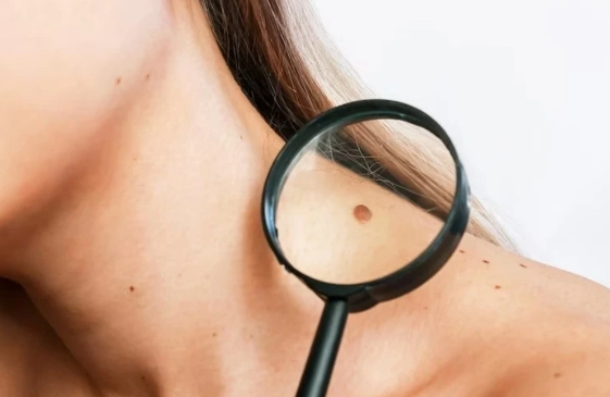 Dəridəki təhlükəli xallarla bağlı rusiyalı onkoloqdan vacib xəbərdarlıq