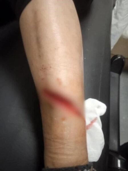 Qadın sahibsiz itlərin hücumunə məruz qaldı! İndi isə ayağa qalxa bilmir - FOTO+VİDEO