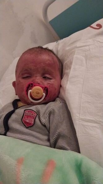 İki yaşlı körpənin başından qaynar su tökülüb: Müalicəsinə 500 manat pul tapmırlar - FOTO