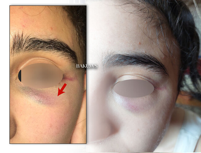 Bakı məktəbində sinif yoldaşları məktəbli qızı vəhşicəsinə döydülər - FOTO/VİDEO