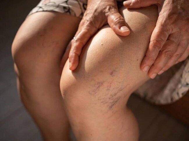 Ayağınızda bu izlər varsa, diqqət! - Beyinlə əlaqəsi üzə çıxdı