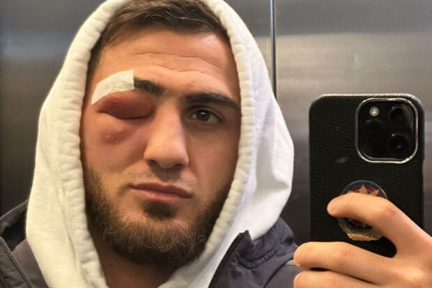 Azərbaycanın sərbəst güləşçisinin gözünə mikrob düşüb: Üzü şişib - VİDEO