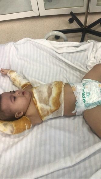 Bədəni yanan daun sindromlu körpənin anası: "Müalicəni etmək üçün imkanımız yoxdur" - FOTO