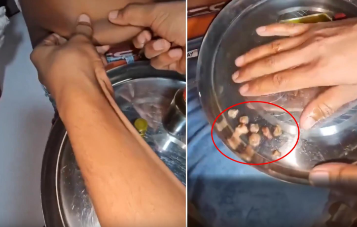 Göbək nahiyəsinə masajla böyrək daşlarını çıxardığını iddia edən şəxsin görüntüləri müzakirə yaratdı - VİDEO