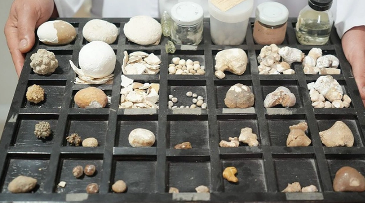 İşi artıq hobbisinə ÇEVRİLİB: 22 ildir xəstələrin böyrək daşlarını YIĞIR - FOTO