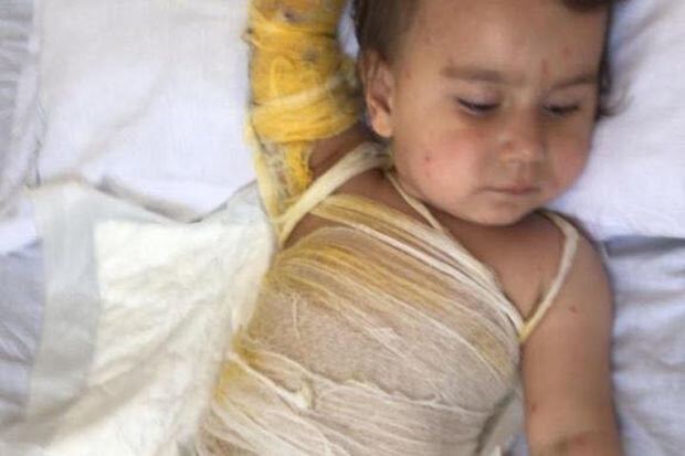 İki yaşlı körpə qaynar su olan vedrəyə yıxılıb: Dəstəyə ehtiyacı var - FOTO