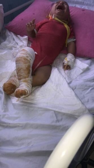 11 aylıq körpənin üstünə qaynar çaydan aşıb: Yardıma ehtiyacı var - FOTO