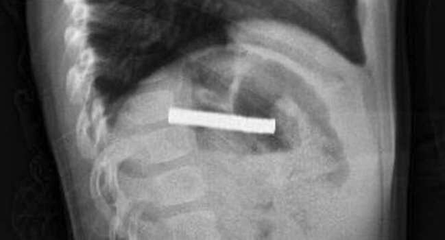 3 yaşlı uşağın boğazından 19 maqnit çıxarıldı