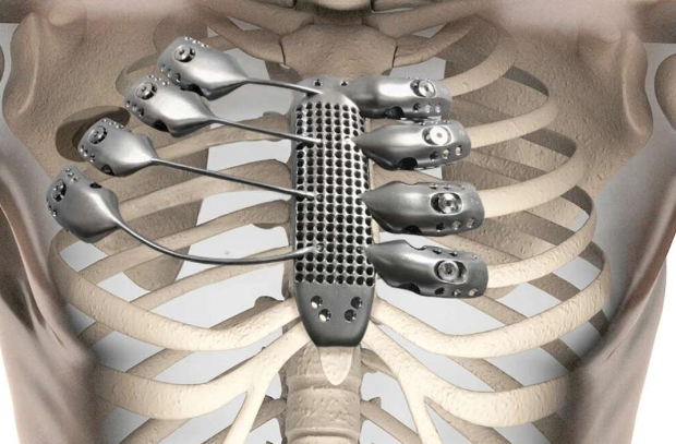 Zədələnmiş sümüklərin sürətli bərpasına imkan verən cihaz yaradılıb