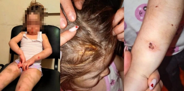 Bakıda ana azyaşlı qızının bədənini yandırdı, kəmərlə döydü - TƏFƏRRÜAT