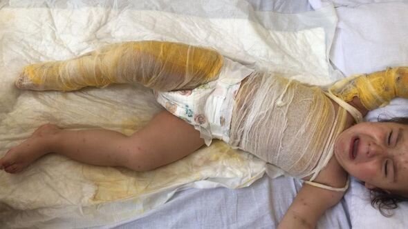 İki yaşlı körpə qaynar su olan vedrəyə yıxılıb: Dəstəyə ehtiyacı var - FOTO