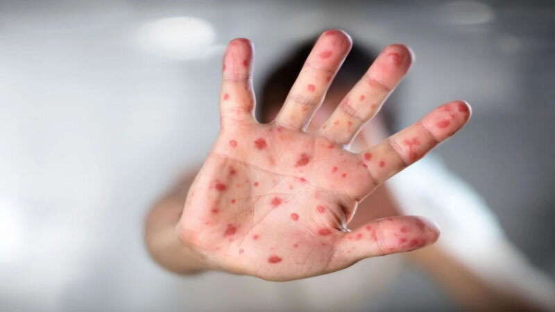 Bu ilin birinci yarısında Azərbyacanda neçə nəfər qızılcaya yoluxub? (RƏSMİ)