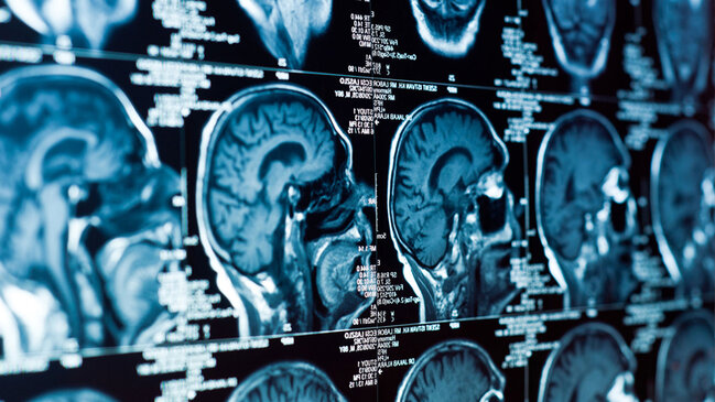 Alimlər: Yalnızlığın beyinə zəhər kimi təsiri var