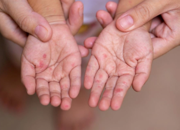 Bakıda şagird qızılcadan ölüb