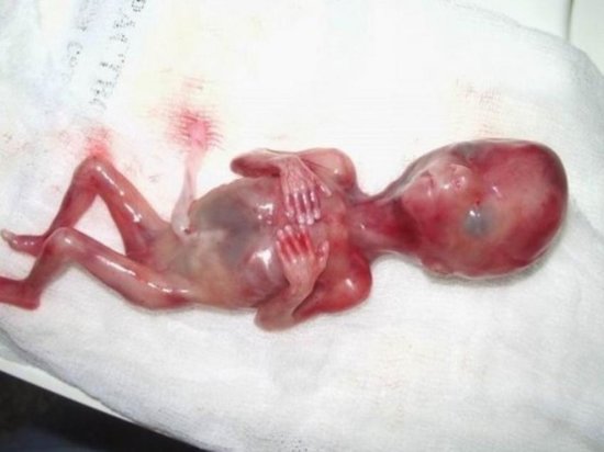 Evdə abortlarla bağlı baş ginekoloqdan SOS: "Bağırsaq, uşaqlıq deşilə, çürüyə bilər"-Sonsuzluq təhlükəsi