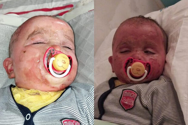 İki yaşlı körpənin başından qaynar su tökülüb: Müalicəsinə 500 manat pul tapmırlar - FOTO