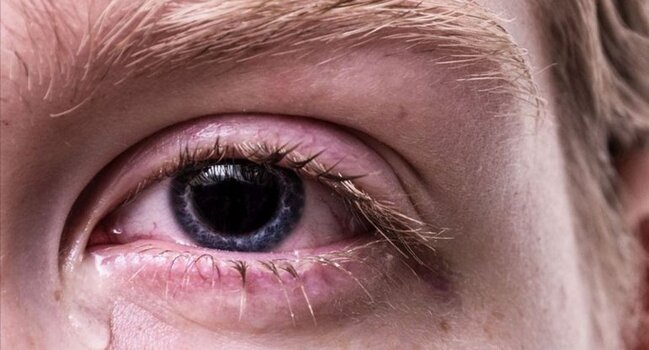 Gözümüzün altı niyə qaralır? - Nə etməli?