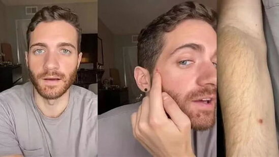 Xəstəlikdən sağalan məşhur aktyor meymunçiçəyi ilə bağlı təcrübəsini bölüşdü - FOTO/VİDEO