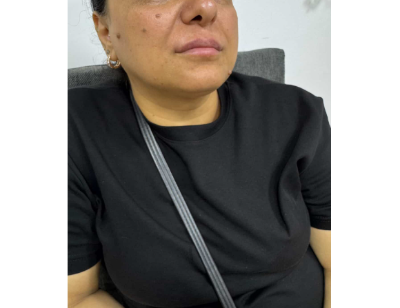 "Seyri Beauty"də saxta kosmetoloq iddiası – müştəri: "Anamın dodaqlarını yanlış texnika ilə korladı" - ŞİKAYƏT