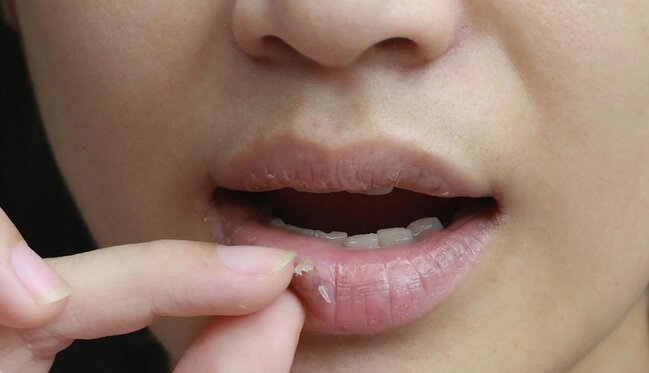 Dodaqların tez-tez quruması hansı xəstəliyin siqnalıdır?