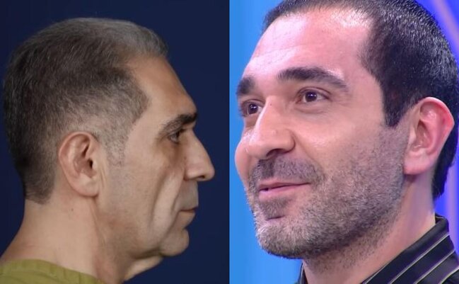 Nurlan Əzizbəyli plastik əməliyyatla üzünü dəyişdirdi - Fotolar