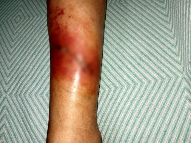 Qadın sahibsiz itlərin hücumunə məruz qaldı! İndi isə ayağa qalxa bilmir - FOTO+VİDEO