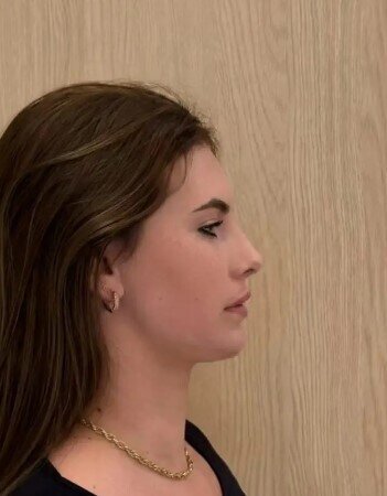 Çənə nahiyəsində aparılan cərrahi müdaxilədən sonra keçirdiyi dəyişiklik heyrət doğurdu - FOTO