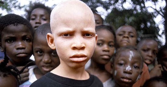 Afrikada albinos uşağın əlini kəsdilər