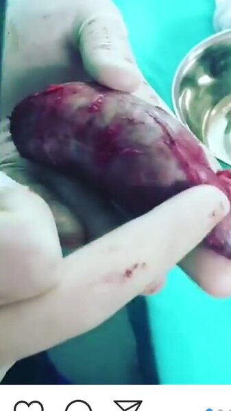 Bakıda xəstənin öd kisəsindən çıxan daş həkimi şoka saldı