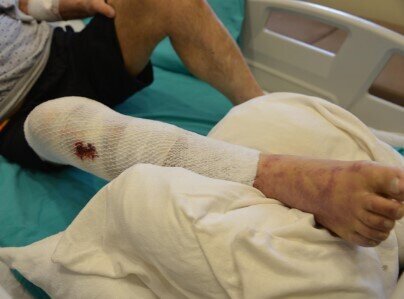 Tutulmuş kanalizasiya borusunu açmaq istəyərkən yandı - FOTO