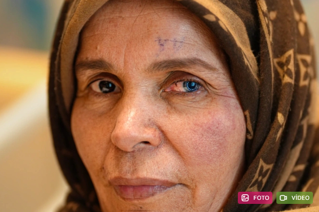 Türkiyədə əməliyyat keçirən qadının gözlərinin hərəsi bir rəngdə oldu