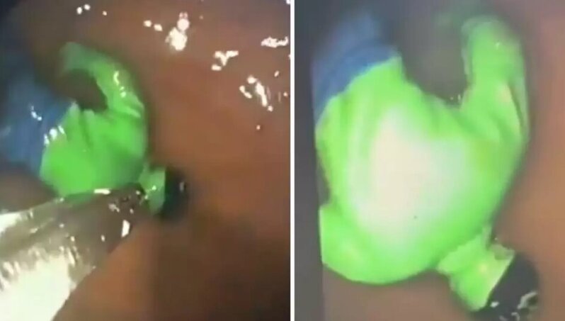 Uşağın mədəsindən "Hulk" çıxdı - VİDEO