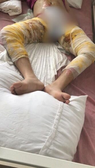 İmkansızlıqdan qızımın yarasını bağlamağa bint ala bilmirik: Zülfiyyənin sizin köməyinizə ehtiyacı var - FOTO