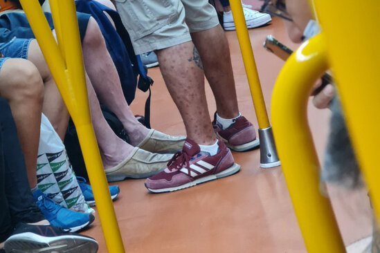 Həkim meymunçiçəyinə yoluxanı metroda aşkar etdi