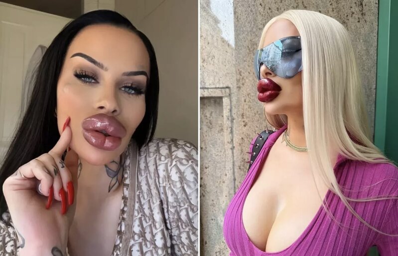 Estetik əməliyyatlara 60 min dollar xərcləyən fenomen: "Artıq ağzımı bağlaya bilmirəm"