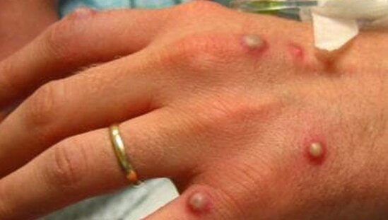 Bu ölkədə meymunçiçəyinə ilk yoluxma faktı qeydə alınıb