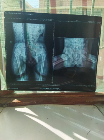 Yeddi yaşlı Aytən təcili əməliyyat olunmalıdır - FOTO