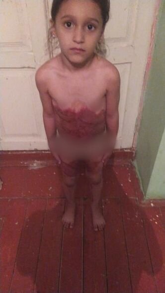 Yeddi yaşlı məktəbli qız ağır yanıq xəsarətləri alıb - FOTO