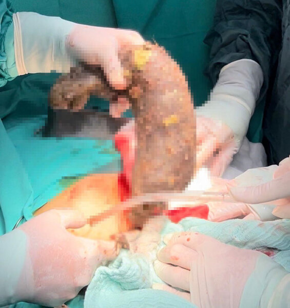 Qadının mədəsindən çıxanlara həkim belə inana BİLMİR - Tam 50 santimetr UZUNLUĞUNDA... FOTO+VİDEO