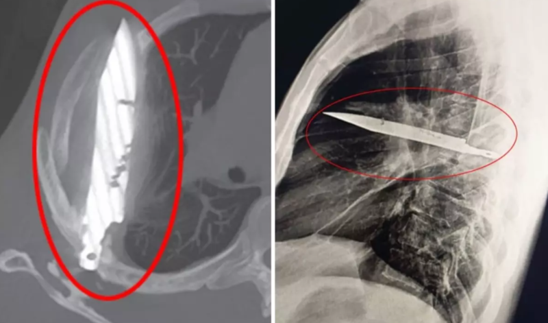 Ağrı ilə xəstəxanaya getdi, sinəsində 8 ildir bıçaqla yaşadığı ortaya çıxdı